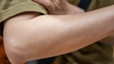 hautabstrich Parkinson diagnostizieren: Ein Arm