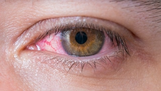 Gerötetes Auge (Bindehautentzündung)