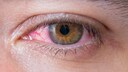 Gerötetes Auge (Bindehautentzündung)
