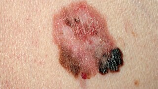 impfung hautkrebs: Bild von schwarzem Hautkrebs