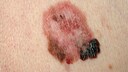 impfung hautkrebs: Bild von schwarzem Hautkrebs