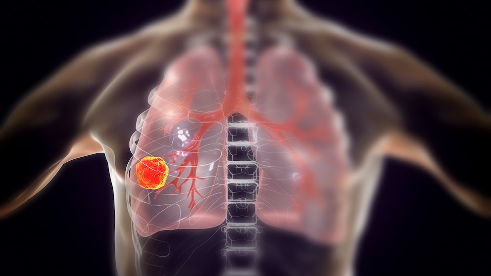 Lungenkrebs erkennen: Illustration von Lungenkrebs