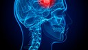 Illustration Hirntumor