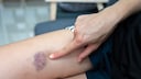 Frau mit Hämatom am Oberschenkel
