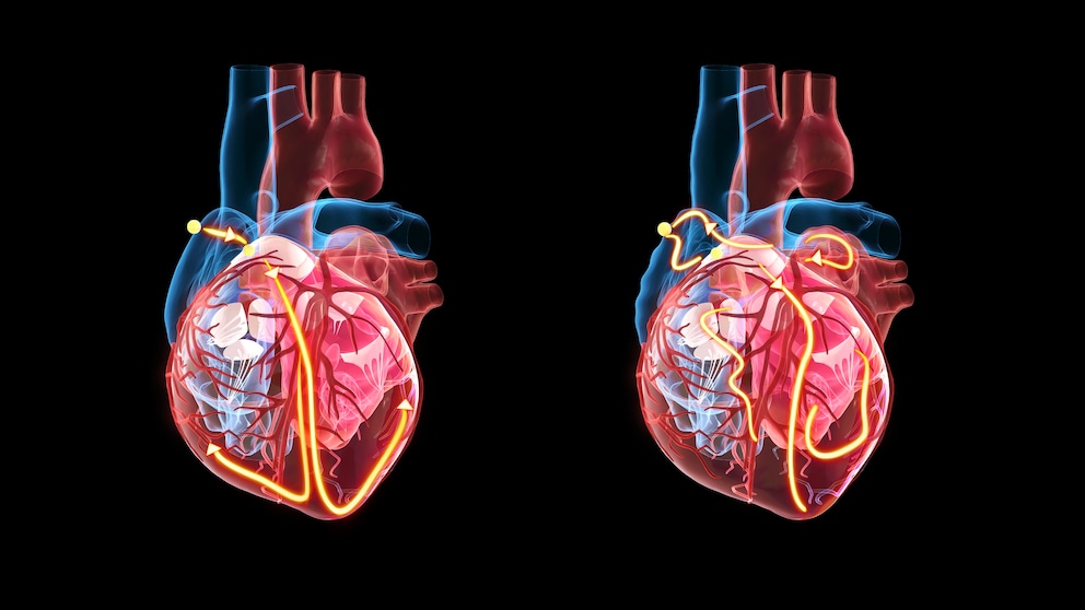 Das Reizleitungssystem des Herzens