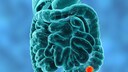 darmkrebs lebensmittel: Illustration eines Tumor im Darms