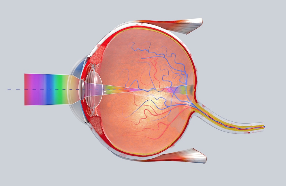 Bild vom Aufbau eines Auges. Rote und blaue Fäden bilden die Netzhaut, welche im Endstadium der Krankheit stark degeneriert ist