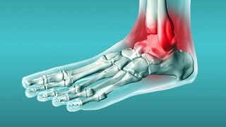 Bei einem Syndesmosebandriss hat man Schmerzen im Sprunggelenk