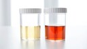 urin Farbe gesundheit: Verschiedene Urinproben