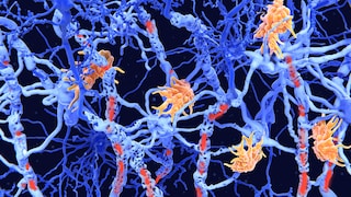 Die Nervenzellen (blau) werden hier von Autoimmunzellen (gelb) angegriffen, was zur Schädigung des Myelins (rot) führt