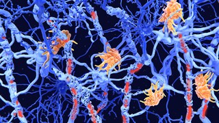 Die Nervenzellen (blau) werden hier von Autoimmunzellen (gelb) angegriffen, was zur Schädigung des Myelins (rot) führt