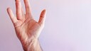 Hand mit Dupuytren-Symptomen