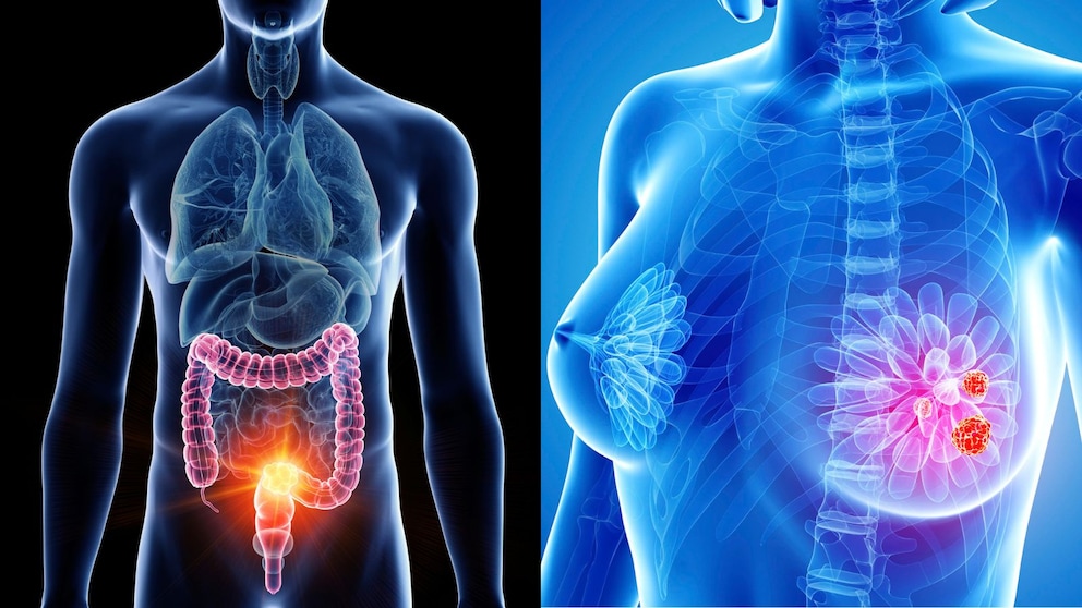 Vorsorgeuntersuchungen ab 50: Darmkrebs und Brustkrebs
