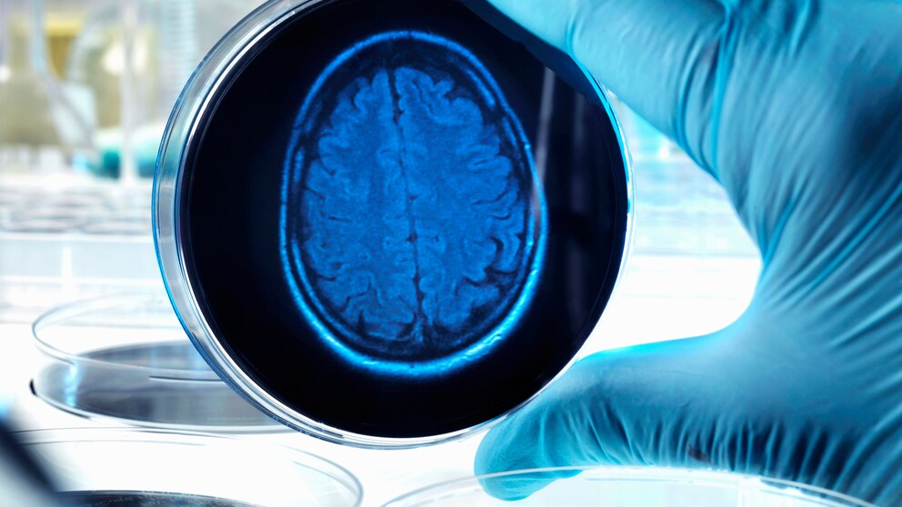 espresso alzheimer: Eine Person hält eine Schale mit einem Gehirn-Röntgenbild