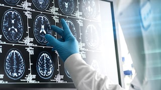 Gehirnscan eines Patienten mit Demenz