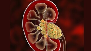Nierensteine Illustration