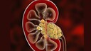 Nierensteine Illustration