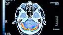 Bildung kann die Entstehung von Alzheimer (Scan eines dementen Patienten) beeinflussen