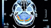 Bildung kann die Entstehung von Alzheimer (Scan eines dementen Patienten) beeinflussen