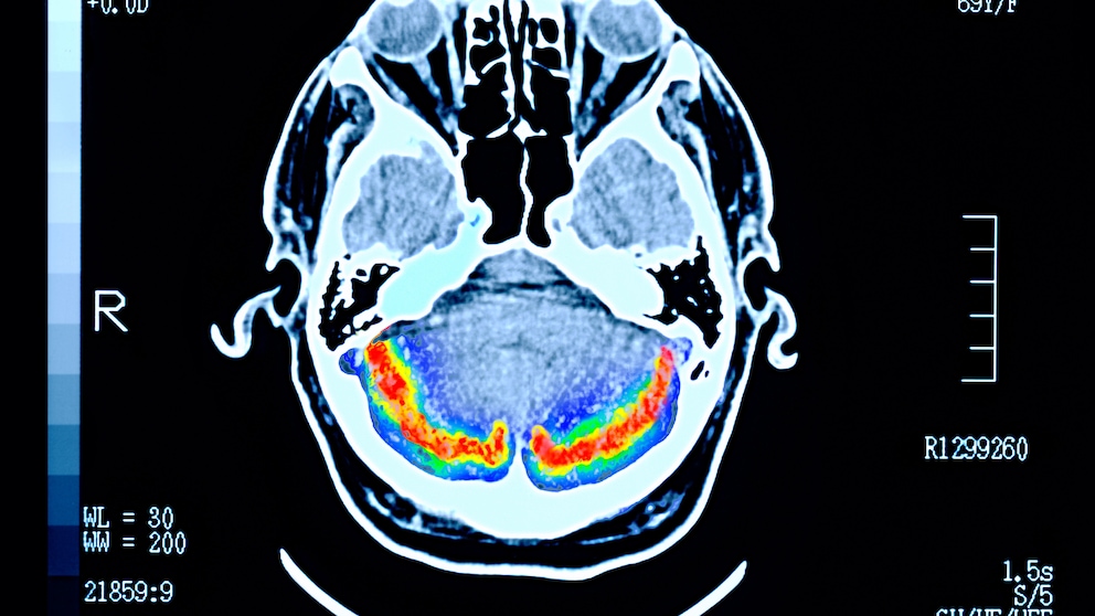 Bildung kann die Entstehung von Alzheimer (Scan eines dementen Patienten) beeinflussen