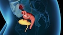 Illustration Endometriose