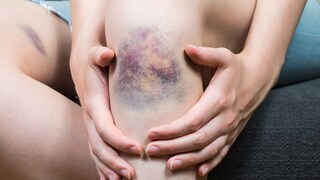 Hämatom (Bluterguss)