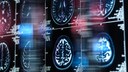 Aufnahmen aus der Alzheimer-Forschung