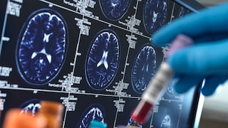 Forscher haben die Proteine im Hirnwasser von Alzheimer-Patienten untersucht und dabei wichtige Erkenntnisse gewonnen