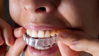 Aligner sind transparent und sitzen eng auf dem Gebiss