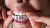 Aligner sind transparent und sitzen eng auf dem Gebiss