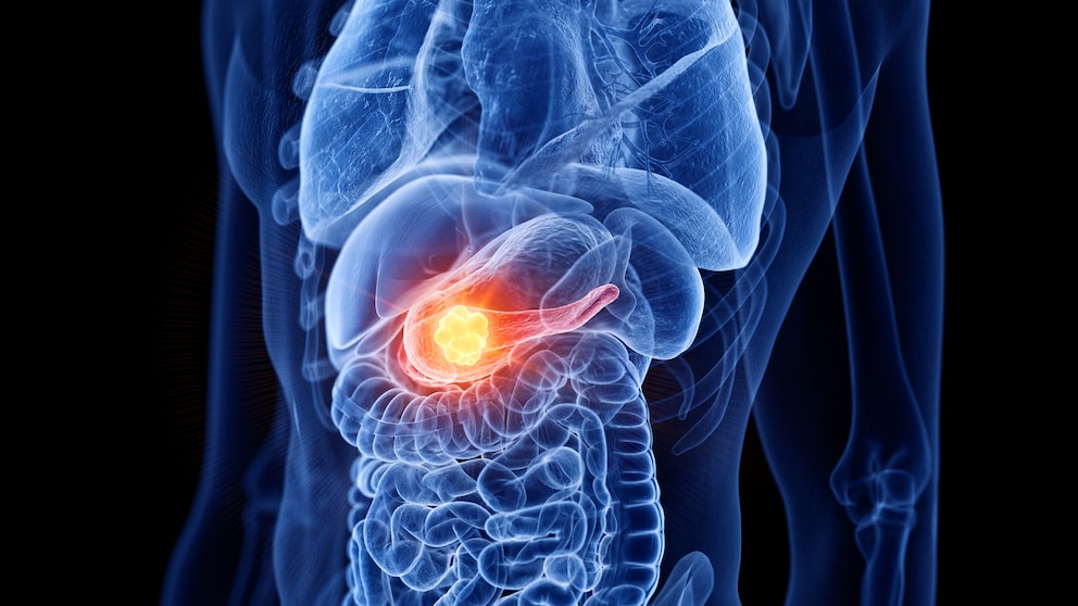 Symptome, Risikofaktoren und Behandlung von Bauchspeicheldrüsenkrebs