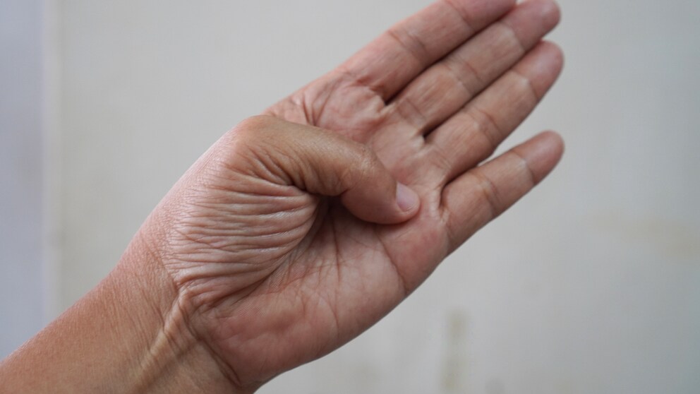 Was sagt der Daumen über das Risiko für ein Aortenaneurysma aus?