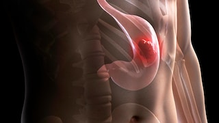 Magenkrebs – Diagnose, Ursachen, Symptome und Behandlung