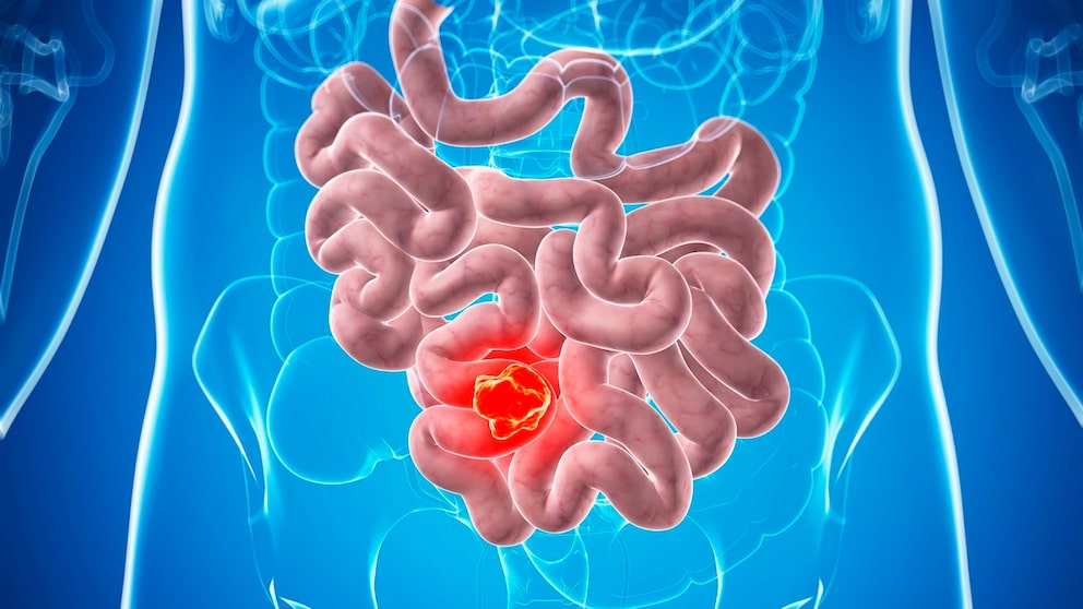 Es gibt einige häufige Symptome von Darmkrebs, die leicht übersehen werden können