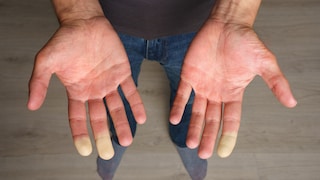 Man showing hands with Raynaud syndrome, Raynaud's phenomenon or Raynaud's disease. High quality photo