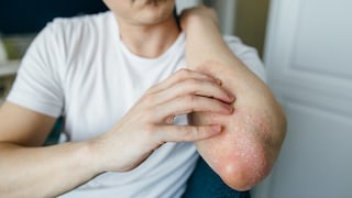 Man scratches the flaky skin on his hands with eczema, psoriasis and other skin diseases such as fungus, plaque, rash and spots. Autoimmune genetic disease.