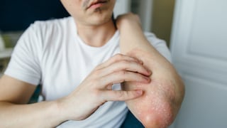 Man scratches the flaky skin on his hands with eczema, psoriasis and other skin diseases such as fungus, plaque, rash and spots. Autoimmune genetic disease.