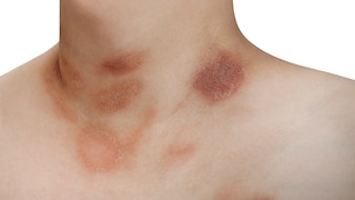 One person with Pityriasis rosea disease on the chest and neck on an isolated background
