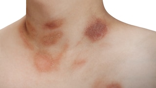 One person with Pityriasis rosea disease on the chest and neck on an isolated background