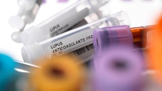 Lupus anticoagulants on a surgical tray.