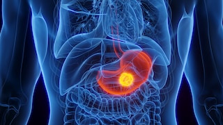 Für das Risiko, Magenkrebs zu entwickeln, ist Nachsalzen keine gute Angewohnheit