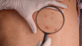 Das Plattenepithelkarzinom ist eine Form von Weißem Hautkrebs