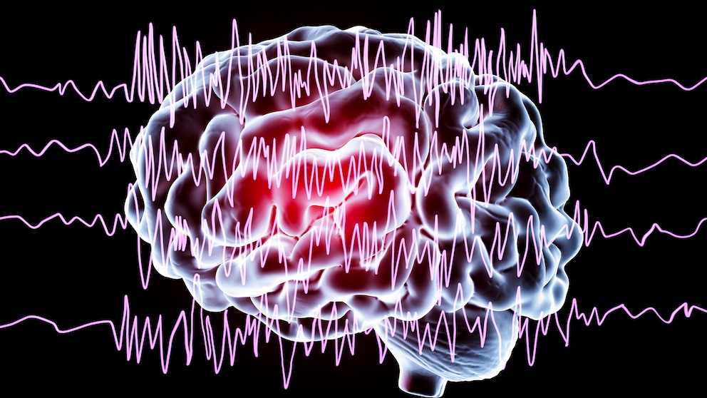 Ein EEG des Gehirns kann anzeigen, ob eine Neigung zu epileptischen Anfällen besteht.