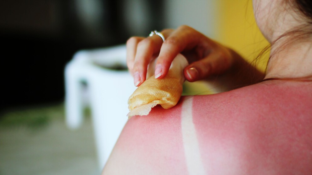 Sonnenbrand Hausmittel