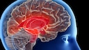 Alzheimer-Symptome: Ein demenzkrankes Gehirn