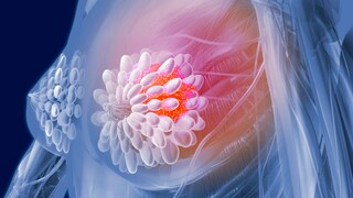 Brustkrebs wird als häufigster Krebs bei Frauen diagnostiziert