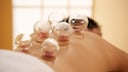 Cupping