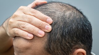 Mittel gegen erblich bedingten Haarausfall