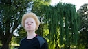 Frau, die an Albinismus leidet