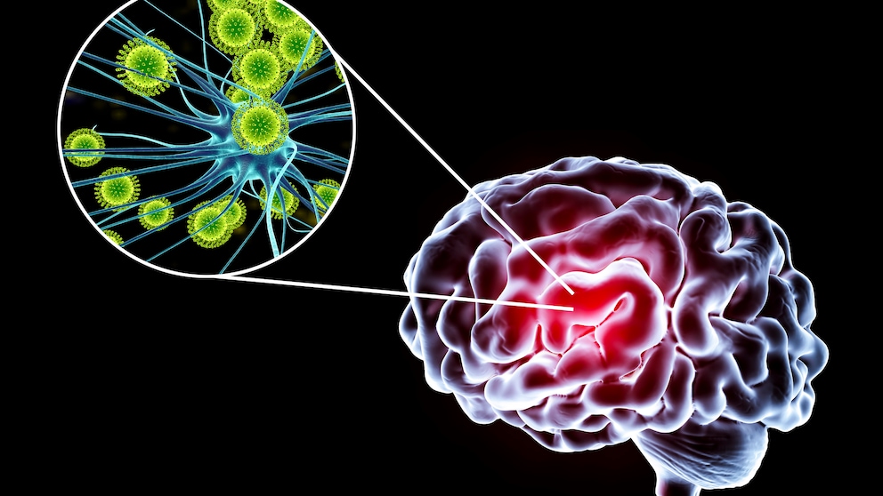 Enzephalitis (Gehirnentzündung)